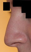 the line on my nostril and between my nostril and cheek is too prominent, can i get rid of this? I know i have a little bump and the tip should be a bit longer - i dont think its THAT big of a problem though is it?