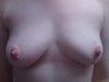 Pre op front view