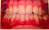My Crossbite