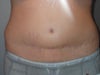 I wonder if a mini tummy tuck would lower my original scar and eliminate the "new" stretchmarks.