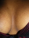 My chest area. Notice the crevasses and the cracks in the skin. Also note the acne spots