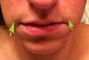 puffiness on either side above upper lip