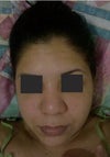 2 Months Post