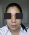 3 Months Post