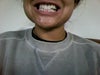 Front Smile