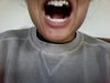 Bottom teeth have minimal movement