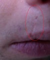 Lip scar