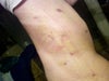 Bruises down the side of my torso.  They are not causing much discomfort.