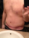 17 Days Post-Op. Protrusion at Xiphoid Process