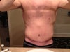 17 Days Post-Op. Protrusion at Xiphoid Process