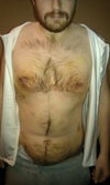 2 weeks after surgery.