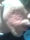 (some bumps might look like acne, but actually are scars)