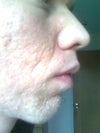 The texture of my skin is disgusting. It's full of bumps that look like small acne.