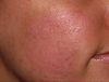 skin seems damage after jessener peel