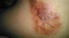 nipple and surrounding scar tissue
