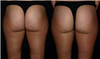 Smoothshapes Before and After Photos