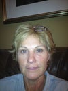 after v beam, swollen or raised under eye