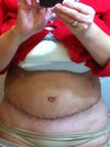 My high scar