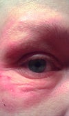 Large inset wrinkles