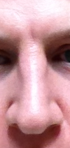 "3 weeks post" Picture.  I realize that this picture is at a different angle, but you can see that it's wider at the top that the middle (and looks crooked).