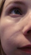 Facial Scar