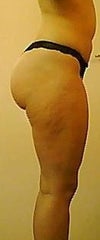 buttocks right side