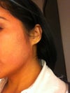 rash on face, mostly sides and forehead. Not chin or center of face