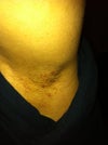 Underarm after 4th laser treatment