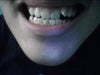 My tooth on the right side of this picture is crooked will invisalign work?