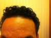 Picture of forehead