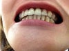 my overjet on my right side after 23 trays