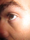This is the other non affected eye.