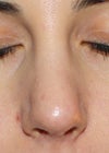 6 weeks post-op, nose 'leans' to the right.