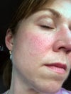 This my right cheek it is the worse of the 2 sides.. so you can have an idea of what the issues are.