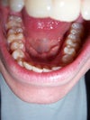 Lower arch as example.