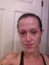 This is before the radiesse. I look horrible!