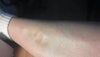 Edema on leg