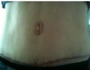 Belly button 4 months post op