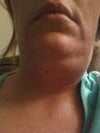 @ days After lipodissolve uneveven swellinmg on one side. Extremely embaressing to walk arounf like thios!