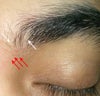 Eyebrow loss area