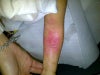 This picture was taken a few days after the scald