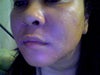 Notice chaffing on new skin - the corners of my mouth are also very dry and cracked.