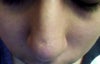 Close up of chicken pox scar on nose