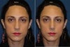 Front view - before and after