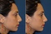 Side profile - before and after