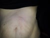 Scar is reddened are to the left above my umbilicus.