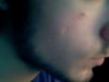 scar with thick tissue at the sides