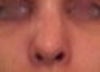 6 weeks post-op. Had an open rhinoplasty that included breaking the nasal bones.