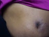 Dark marks around belly button....Just stated happening