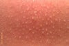 many little bumps/pimples around mouth and towards chin.